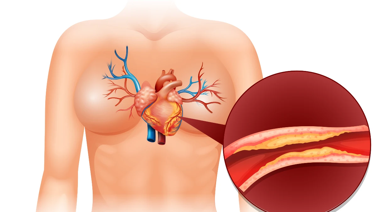 Why Your Cholesterol Won't Drop (Even Though You Eat 'Heart-Healthy' Foods)
